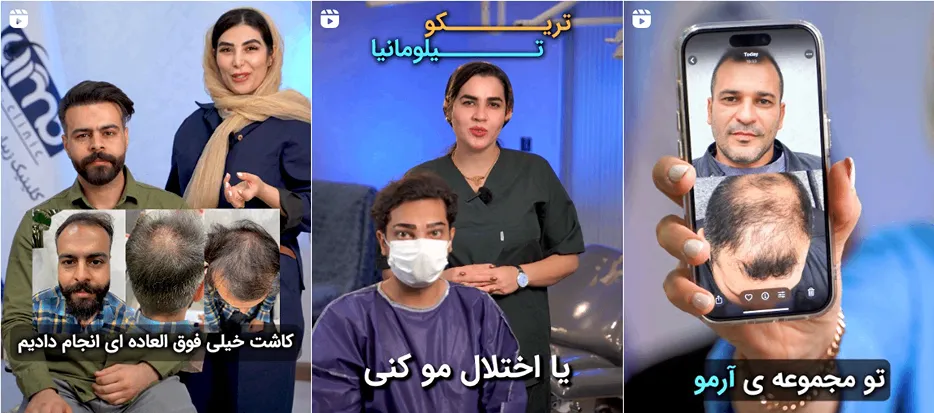 کلینیک آمو از بهترین کلینیک کاشت مو در قزوین است