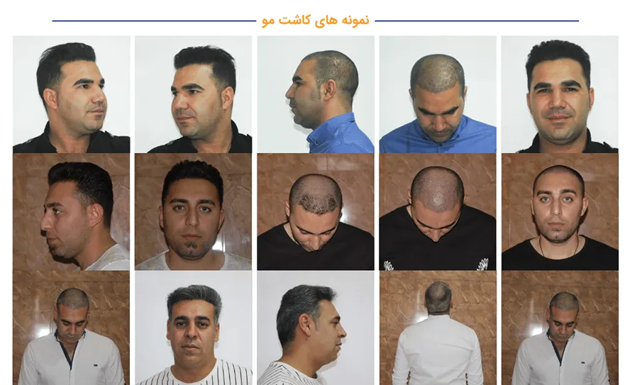 تصویر نمونه کاشت مو ساری که با موفقیت به ارمغان رسیده است