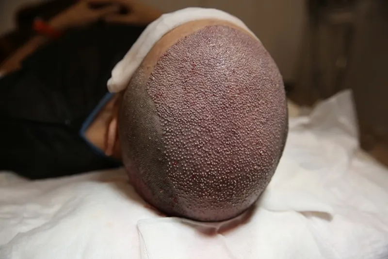 مراقبت از عدم تایش مستقیم نور افتاب بعد از کاشت مو میتواند از اهمیت بسیار ویژه ای برخوردار باشد.