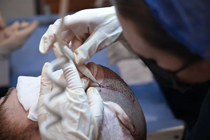 نور افتاب بعد از کاشت مو، تهدیدی بسیار جدی برای فولیکول های تازه کاشته شده است.