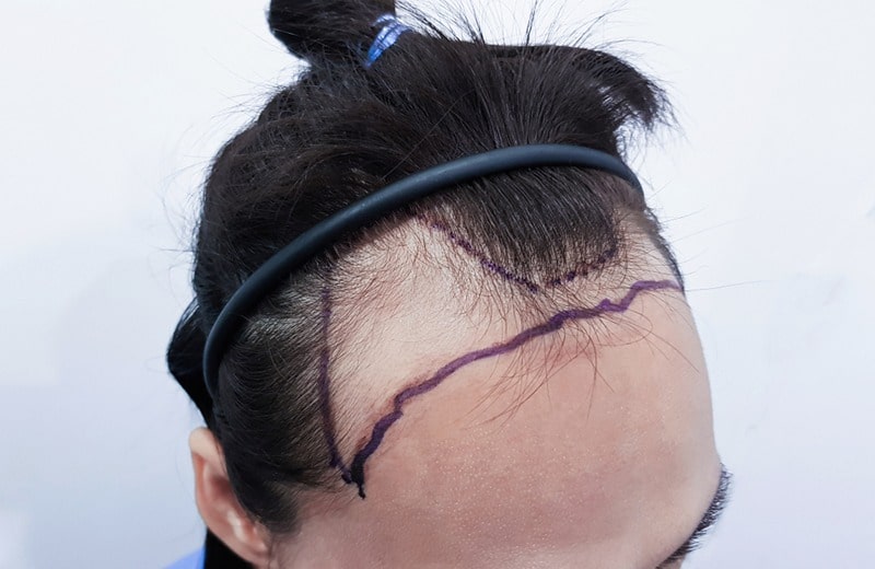 کاشت مو بدون تراشیدن سر، یکی از بهترین روش ها برای خانم هایی است که با ریزش مواجه هستند.