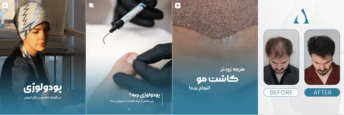 کاشت مو زنجان در کلینیک ابروش کاملا قابل انجام است