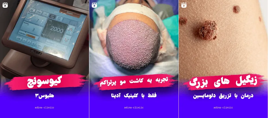 نمونه کار یکی از بهترین مرازک کاشت مو در قم را مشاهده میفرمایید.