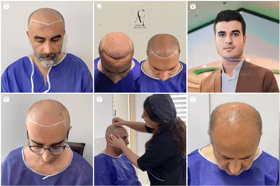 کاشت مو سنندج توسط بهترین متخصصین قابل انجام است