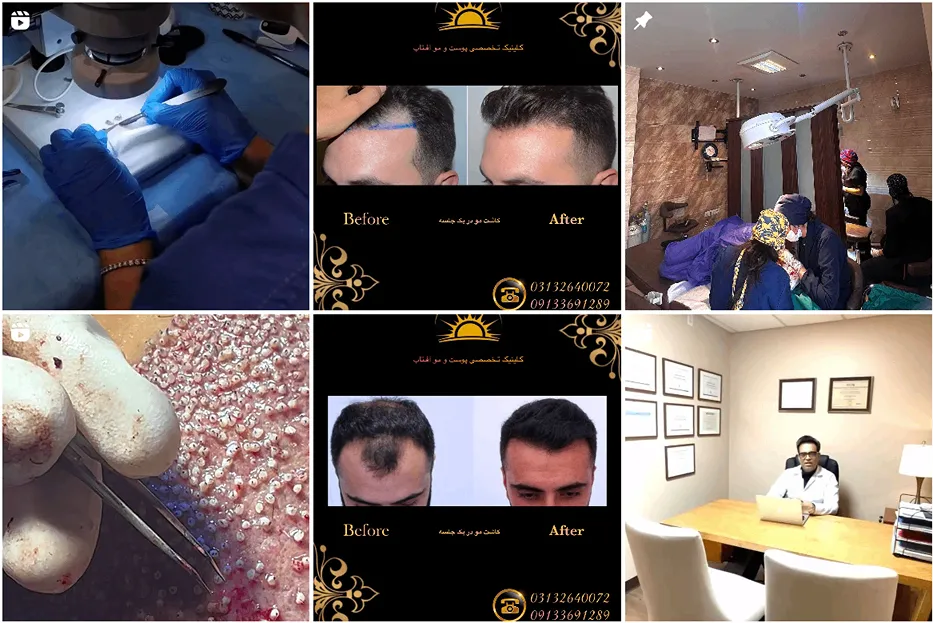 کاشت مو اصفهان در کلینیک افتاب کاملا قابل انجام است