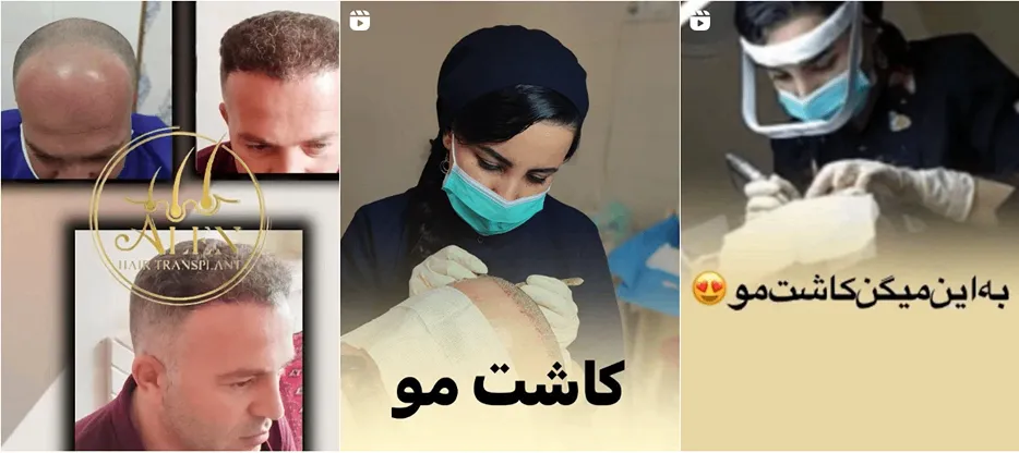 نمونه کار یکی از بهترین دکتر کاشت مو در کرمانشاه را مشاهده میفرمایید.