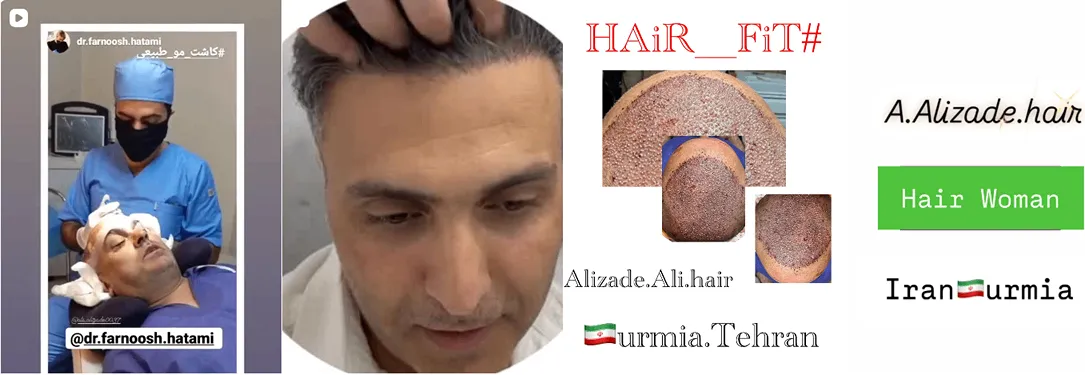 نمونه کار یکی دیگر از بهترین کلینیک کاشت مو در اورمیه را مشاهده میفرمایید.