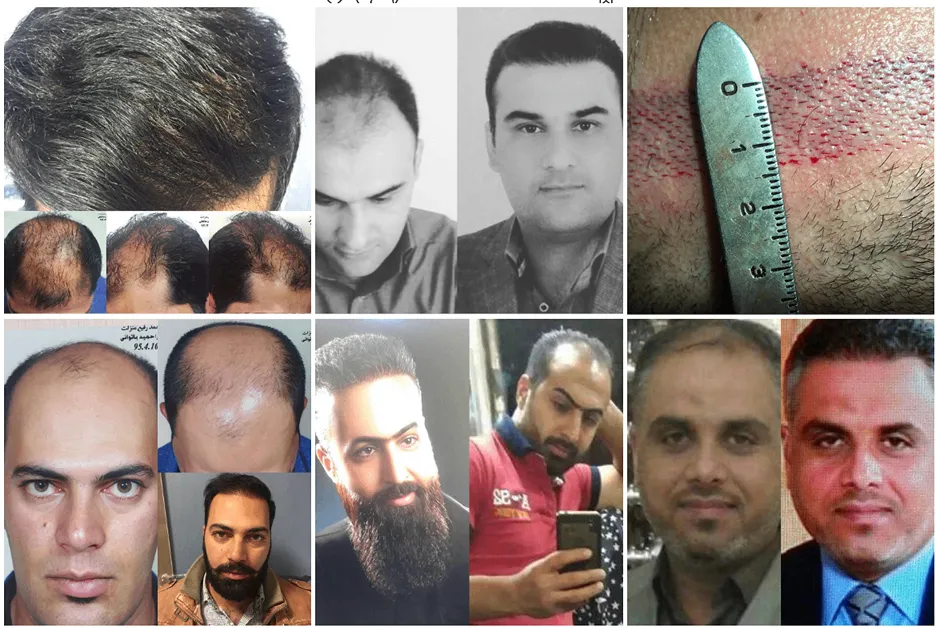 کاشت مو در اصفهان در کلینیک اپادنا کاملا قابل انجام است