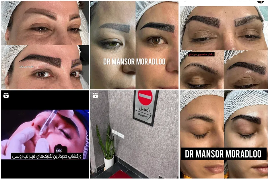 کاشت مو زنجان در کلینیک آریانا کاملا قابل انجام است