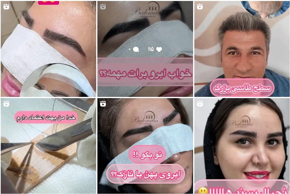 کاشت مو در تبریز در کلینیک بهمنی کاملا قابل انجام است