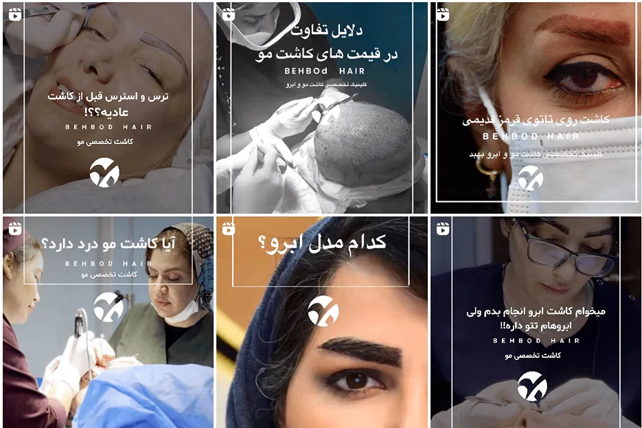 کاشت مو کرج توسط کلینیک بهبد کاملا قابل انجام و رزرو است