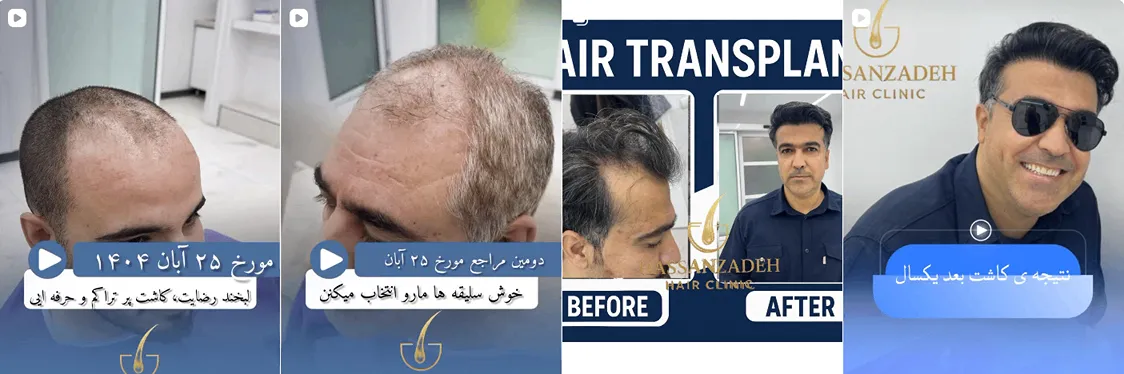 کاشت مو در همدان در کلینیک بهسیما کالما قابل انجام است