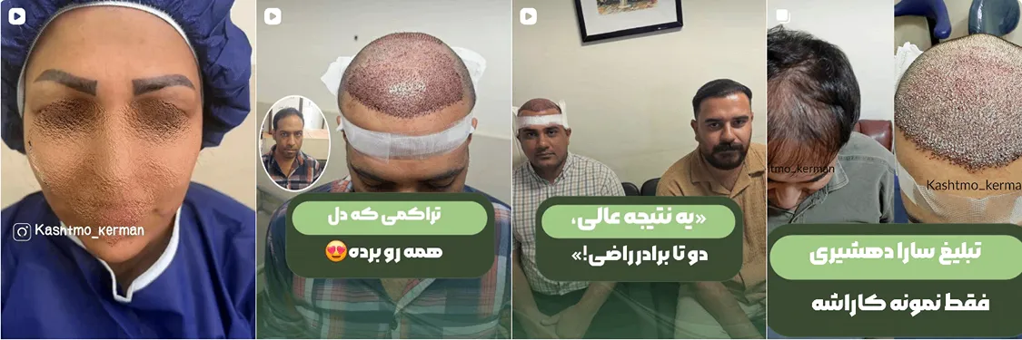 نمونه کار یکی از بهترین دکتر کاشت مو در کرمان را مشاهده میفرمایید.