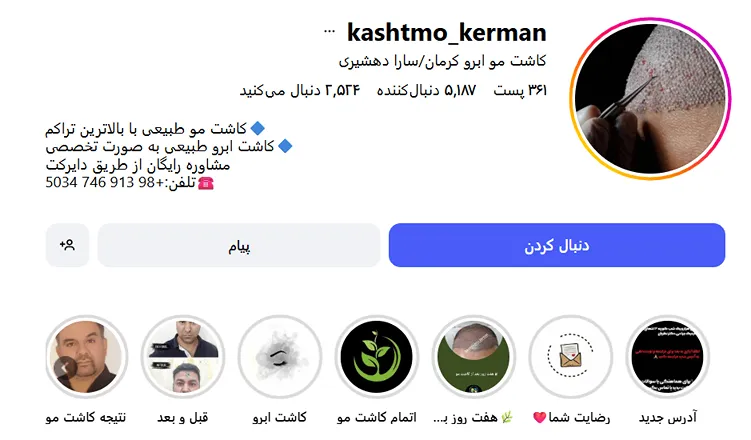 کاشت مو کرمان در کلینیک سارا دهشیری کاملا قابل انجام است