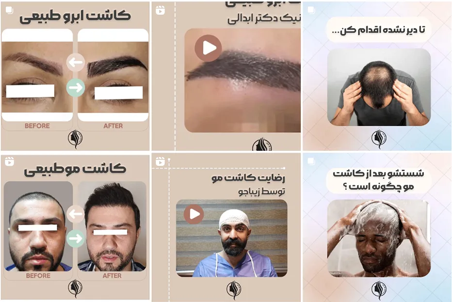 کاشت مو در اصفهان توسط دکتر ابدالی کاملا قابل انجام است