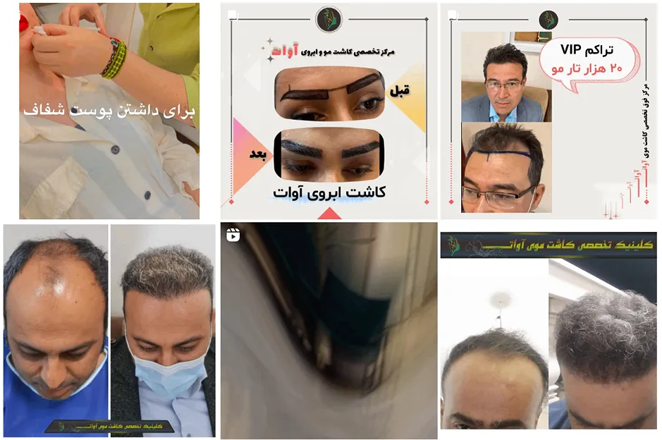 نمونه کار یکی از بهترین کلینیک کاشت مو در کرج را مشاهده میفرمایید.