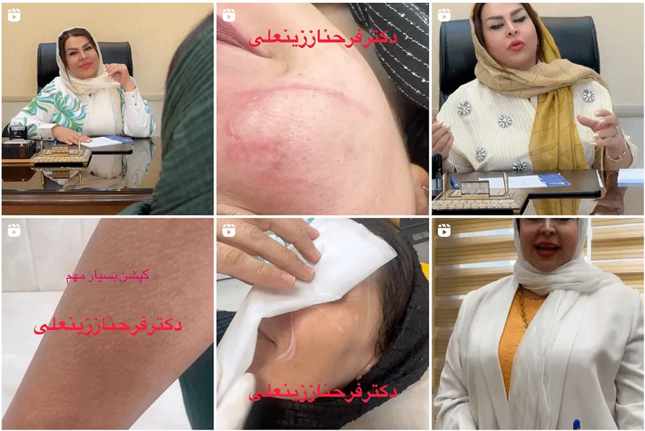 دکتر فرحناز زینعلی یکی از بهترین دکتر کاشت مو در زنجان است