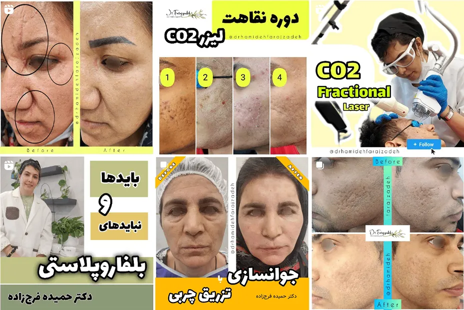 کاشت مو کرج توسط دکتر فرج زاده کاملا قابل انجام است