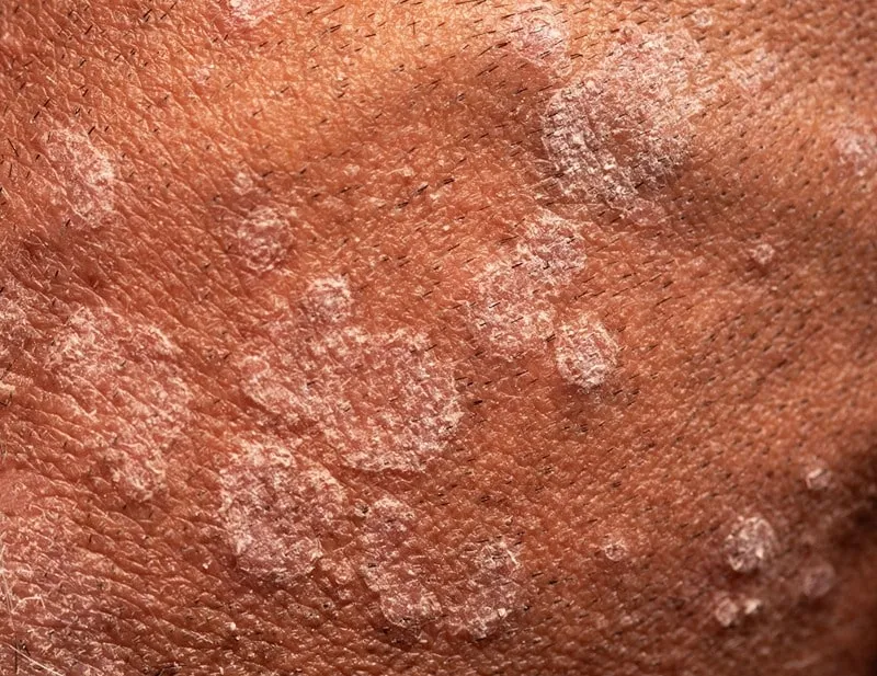 تصویری از عقونت بعد از کاشت مو