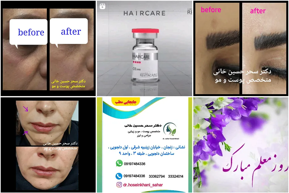 تصویر یکی از بهرتین دکتر کاشت مو در زنجان را مشاهده میفرمایید.