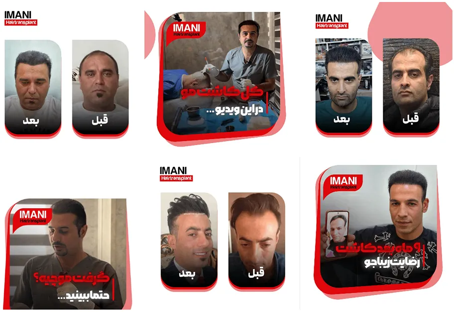 تصوویر یکی از بهترین دکتر کاشت مو در تبریز را مشاهده میفرمایید.