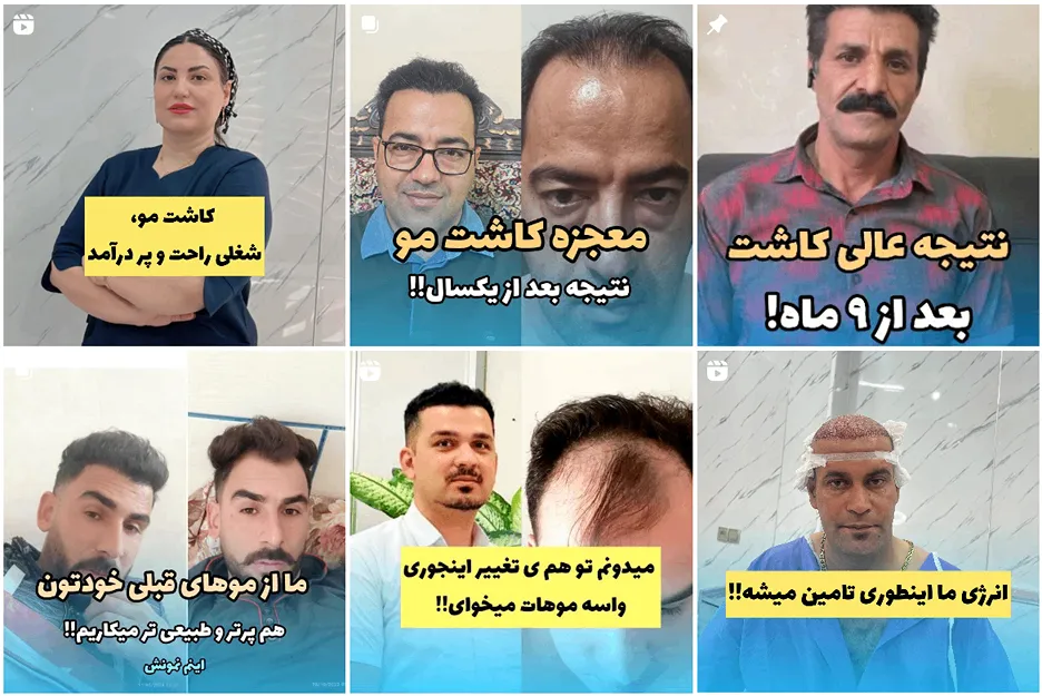 تصویر یکی از بهرتین دکتر کاشت مو در کرمان را مشاهده میفرمایید.