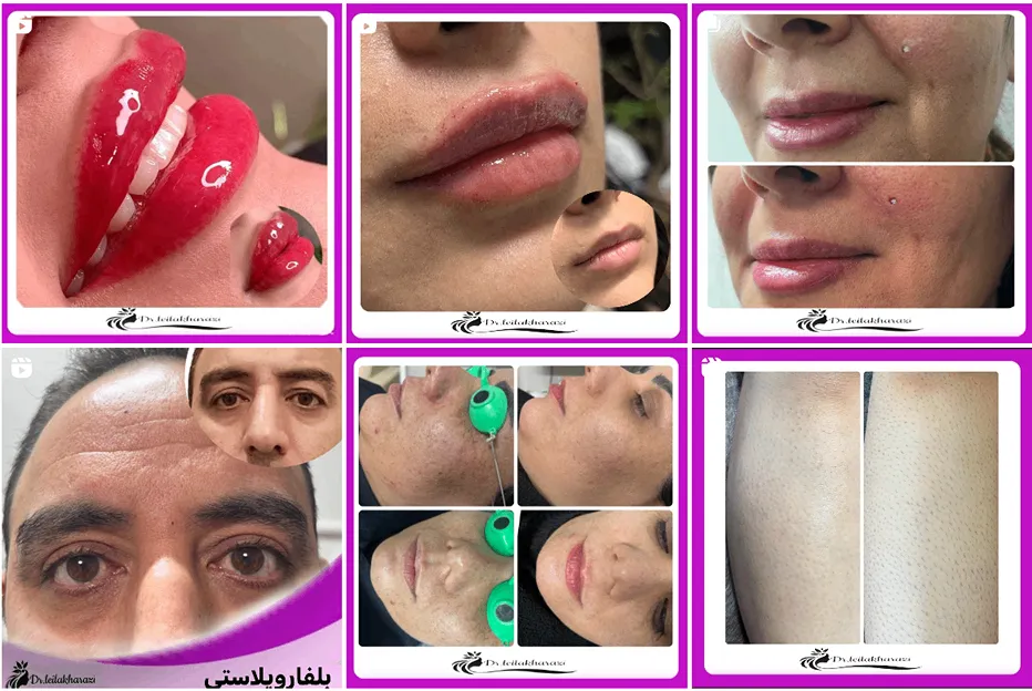 کاشت مو در کرج توسط دکتر خرازی کاملا قابل انجام است