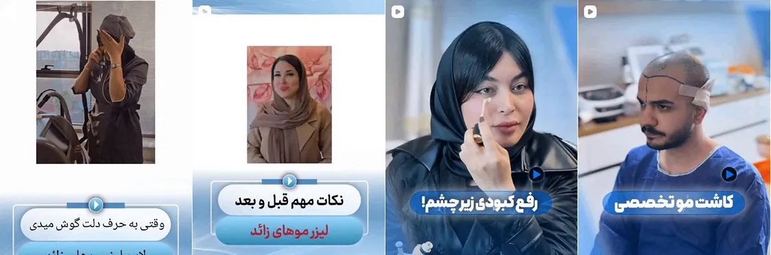 کاشت مو در سساری توسط دکتر جعفری کاملا قابل انجام است