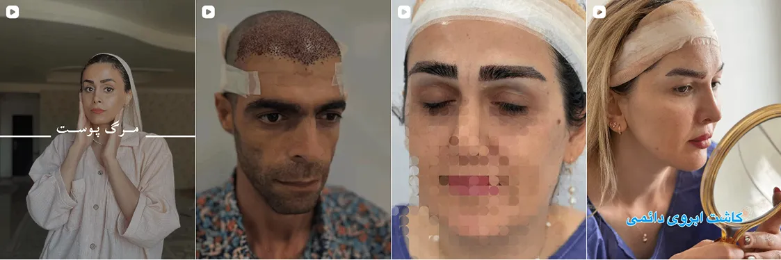 کاشت مو در ساری در کلینیک دکتر مهراسا احمدی کاملا قابل انجام است