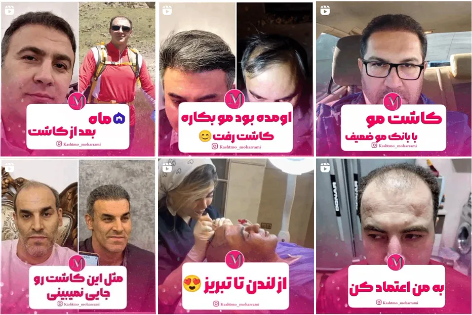 تصویر یکی از بهترین مرکز کاشت مو تبریز را مشاهده میفرمایید.