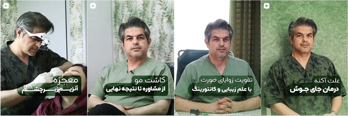 کاشت مو قزوین در کلینیک زیبایی دکتر مولایی کاملا قابل انجام است