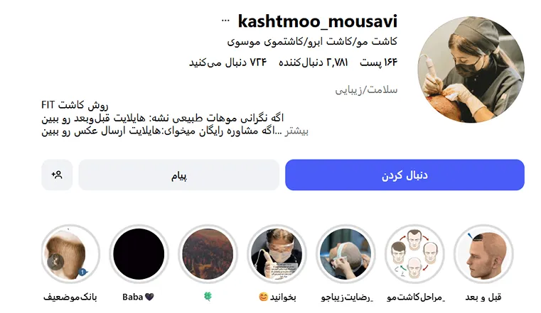 کاشت مو در ارومیه توسط خانم موسوی کاملا قابل انجام است