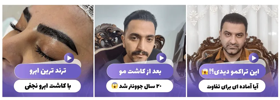 بهترین کاشت مو در تبریز توسط متخصصین مجرب کاملا قابل انجام است