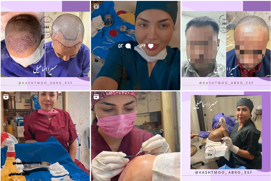 کاشت مو در اصفهان توسط سمیرا اسماعیلی کاملا قابل انجام است