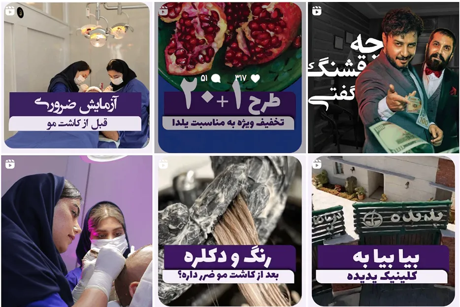 نمونه کار کاشت مو ساری را در کلینیک پدیده مشاهده میفرمایید.