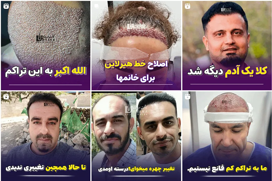 تصویر یکی از بهترین مراکز کاشت مو در کرج را مشاهده میفرمایید.