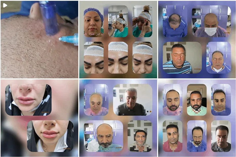 نمونه کار یکی از بهترین دکتر کاشت مو در کرج را مشاهده میفرمایید.