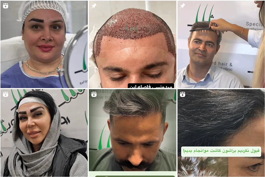 نمونه کار یکی از بهرتین دکتر کاشت مو در همدان را مشاهده میفرمایید.
