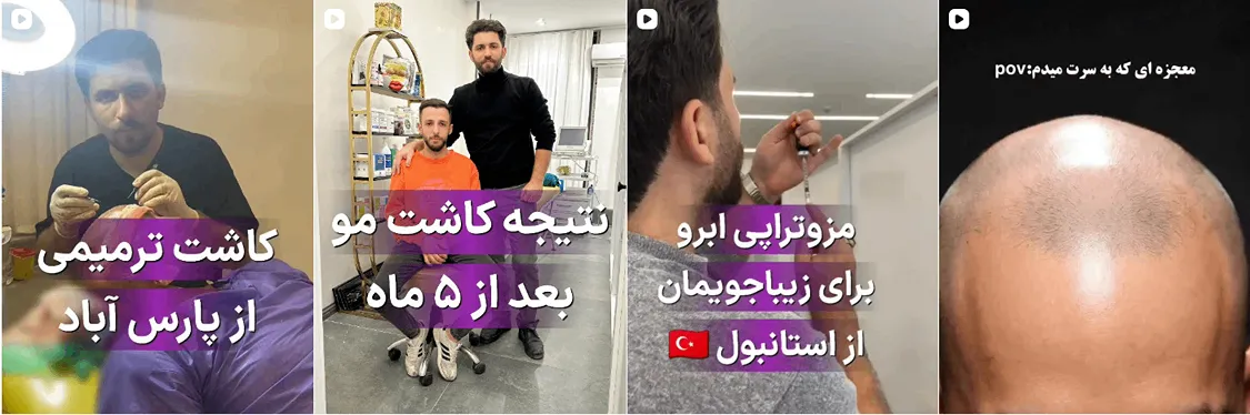 کاشت مو در اردبیل در توسط سعید قهرمانی کاملا قابل انجام است