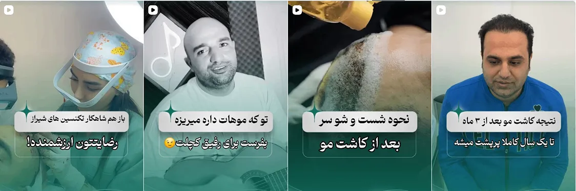 کاشت مو یزد توسط خانم شریفی کاملا قابل انجام است