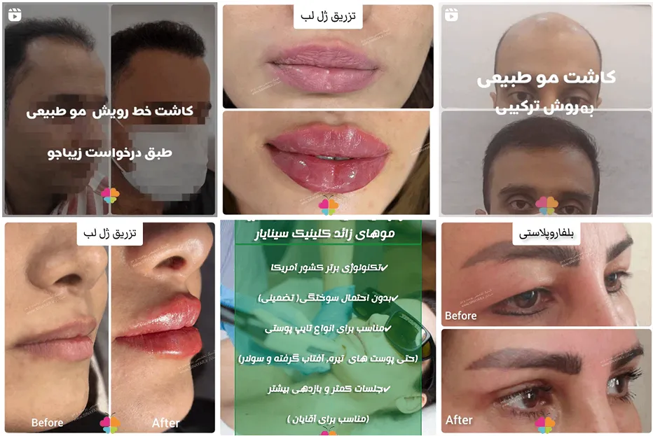 کاشت مو در اثفهان در کلینیک سینایار کاملا قابل انجام است