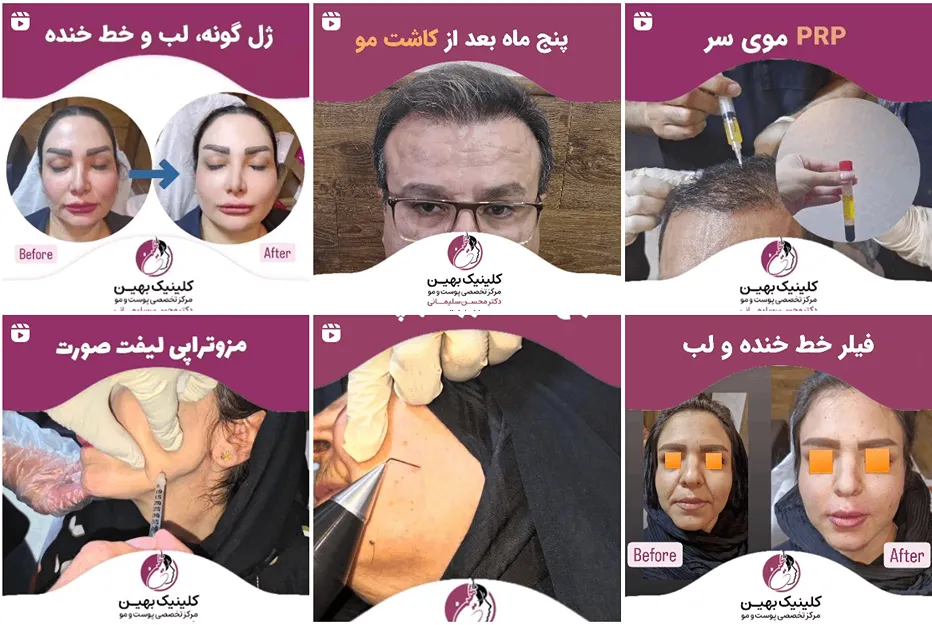 دکتر محسنی از بهرتین دکتر کاشت مو در اصفهان است