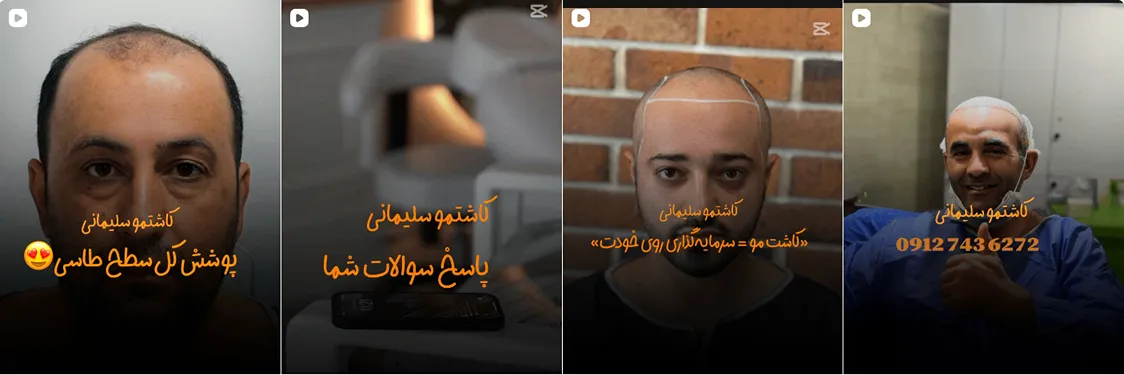 کاشت مو زنجان در کلینیک خانم سلیمانی کاملا قابل انجام است