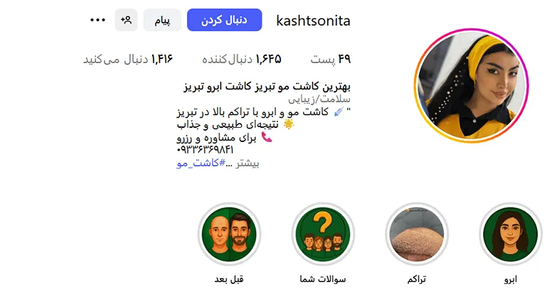 کاشت مو در تبریز در کلینیک کاشت مو تخصصی سونیتا کاملا قابل انجام است