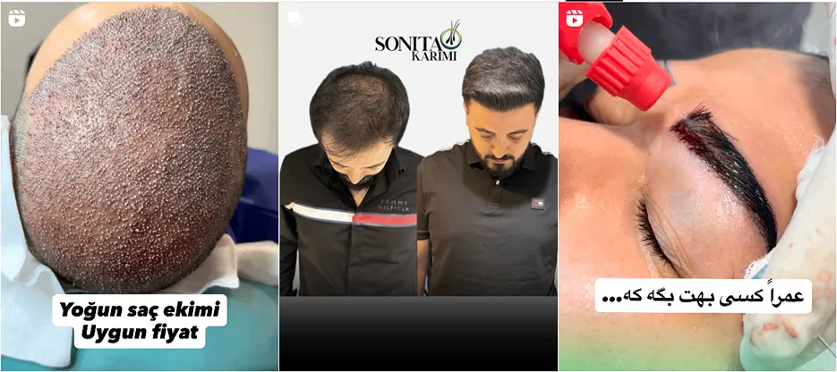 نمونه کار یکی از بهرتین دکتر کاشت مو در تبریز را مشاهده میفرمایید.