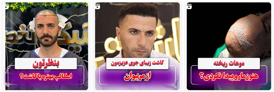 کاشت مو در کردستان توسط تیم تال کاشت کاملا قابل انجام است