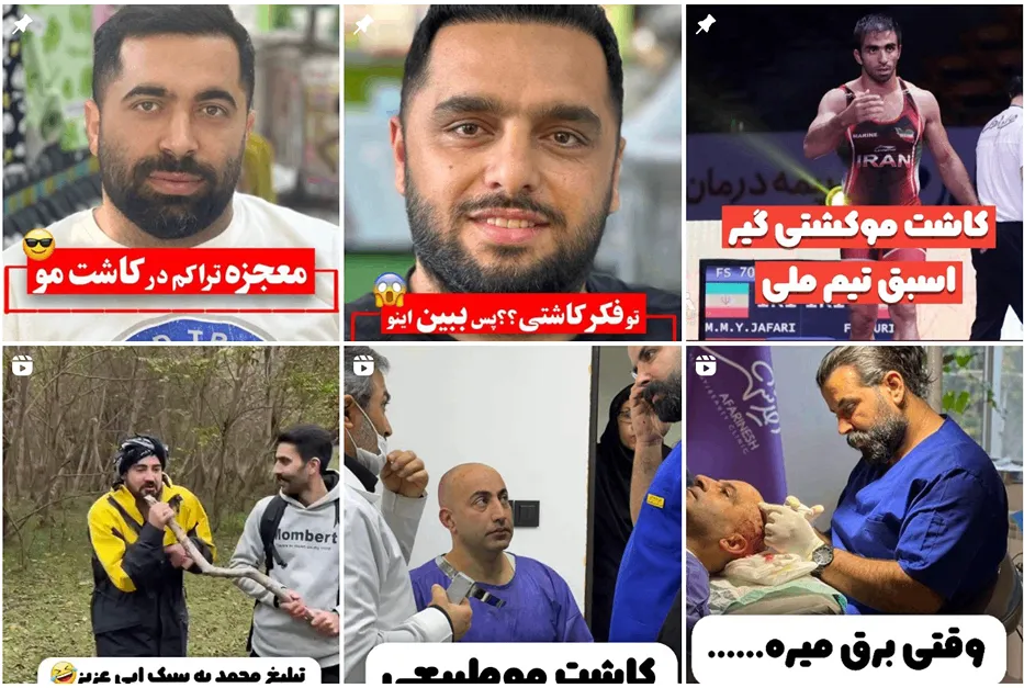 نمونه کار بهترین دکتر کاشت مو در مازندران را مشاهده میفرمایید.