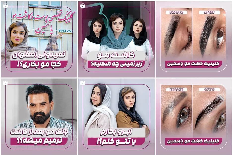 نمونه کار بهترین کلینیک کاشت مو در اصفهان را مشاهده میفرمایید