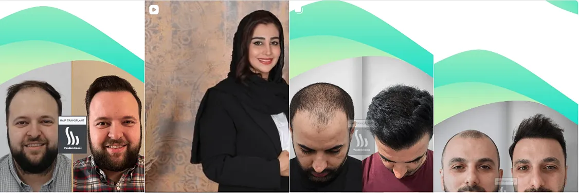 نمونه کار بهترین دکتر کاشت مو در یزد را مشاهده میفرمایید.