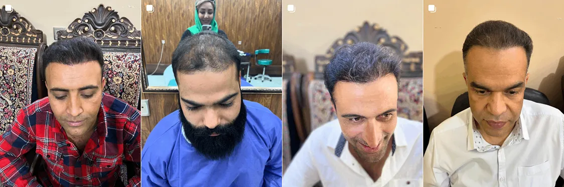 نمونه کار یکی از بهترین دکتر کاشت مو در کرمان را مشاهده میفرمایید.
